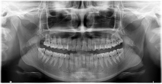 Snmek z panoramatickho rentgenu